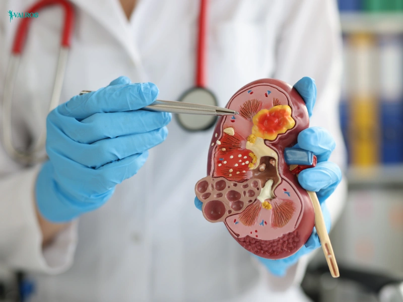 What are the Symptoms of a Kidney Stone Disorder